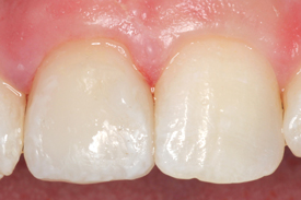 Anterior Single Veneer by Johnson Family Dentistry Devils Lake ND