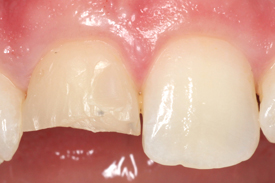 Anterior Single Veneer by Johnson Family Dentistry Devils Lake ND