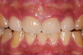 Anterior Cerec Crowns by Johnson Family Dentistry Devils Lake ND