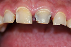 Anterior Cerec Crowns by Johnson Family Dentistry Devils Lake ND