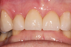 5 Anterior Cerec Crowns by Johnson Family Dentistry Devils Lake ND