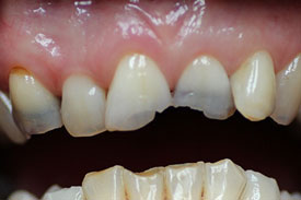 5 Anterior Cerec Crowns by Johnson Family Dentistry Devils Lake ND