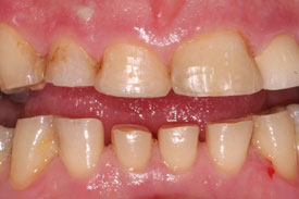 Anterior Composite Fillings by Johnson Family Dentistry Devils Lake ND