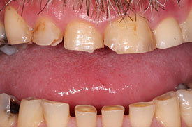 Anterior Composite Fillings by Johnson Family Dentistry Devils Lake ND