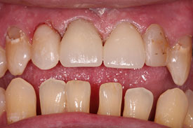 Crowns and Fillings by Johnson Family Dentistry Devils Lake ND
