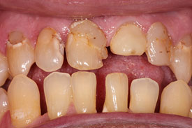 Crowns and Fillings by Johnson Family Dentistry Devils Lake ND